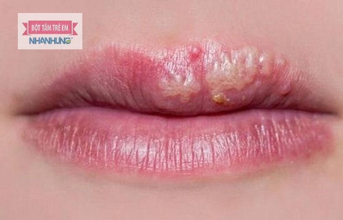 Viêm môi dị ứng gây khô sần, bong tróc và xuất hiện mụn nước li ti trên môi.