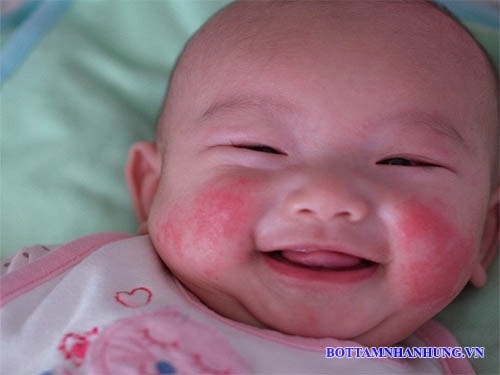 Trẻ bị chàm sữa nổi đốm đỏ trên da và ngứa.