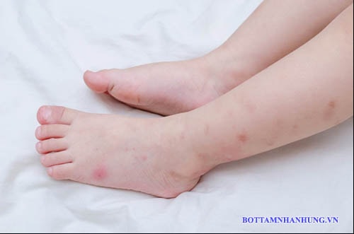 Trẻ bị viêm da tiếp xúc sẽ gây nổi đốm đỏ trên da.