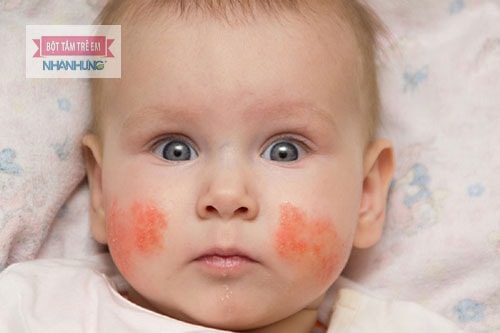 Chàm sữa khiến da mặt trẻ nổi mẩn ngứa thành từng mảng.