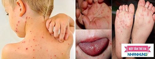  Phân biệt triệu chứng bệnh phỏng dạ với tay chân miệng