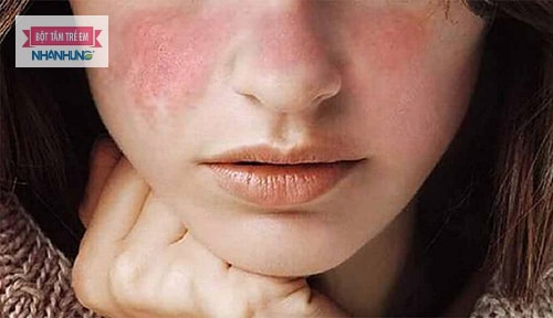 Da mặt khô ngứa mẩn đỏ do chịu tác động của các yếu tố bên ngoài.