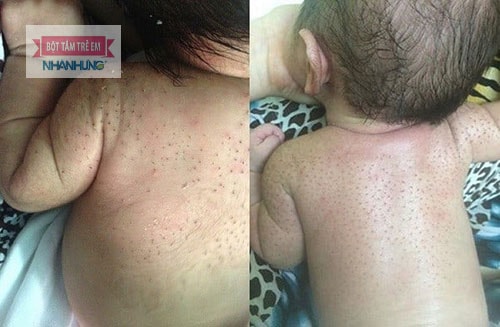 Trẻ mọc nhiều lông ở lưng thường là lông đẹn hay lông tơ.