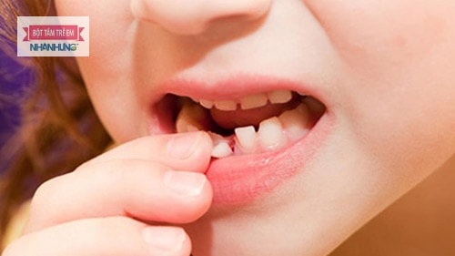 Răng sữa lung lay bao lâu thì nhổ được - Khoảng 1 tuần hoặc vài ngày nếu thấy chân răng của bé còn ít