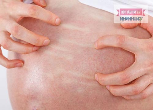 Thân nhiệt cao, tiết nhiều mồ hôi là nguyên nhân khiến bà bầu mắc rôm sảy