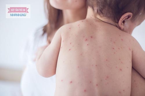 Sốt xuất huyết ở trẻ em do virus Dengue gây ra