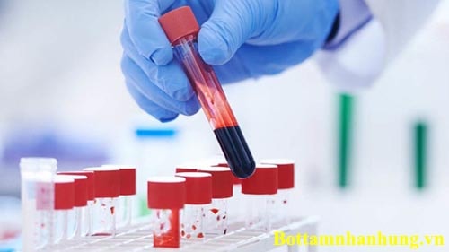 Nhiều xét nghiệm sốt xuất huyết được chỉ định