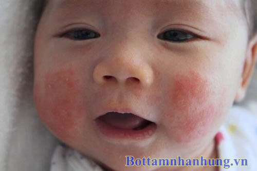 Chàm sữa có thể gặp ở 30% trẻ sơ sinh và trẻ nhỏ