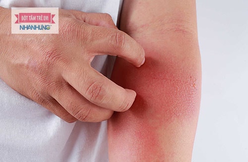 Viêm da dị ứng tiếp xúc là phản ứng của da do tiếp xúc với một số chất kích ứng.