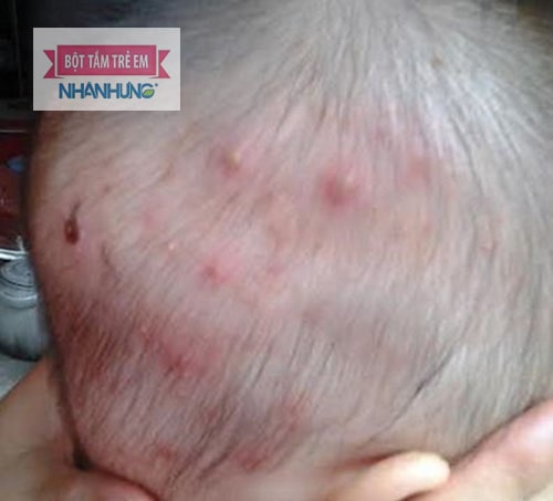 Mụn nhọt có thể gây nhiễm trùng huyết rất nguy hiểm