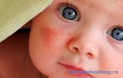 Chàm sữa khiến trẻ khó chịu, quấy khóc