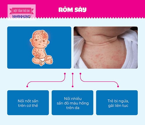 Rôm sảy là bệnh lý ngoài da rất phổ biến trong mùa hè