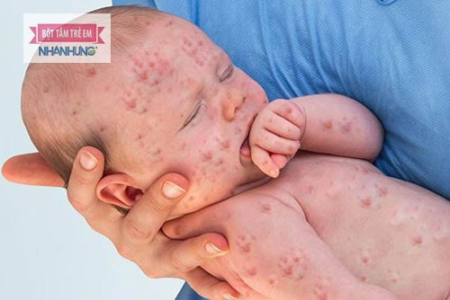 Trẻ có thể mắc nhiều bệnh ngoài da trong mùa hè
