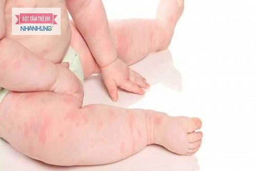 Chỉ cần một tác động nhỏ từ môi trường sống cũng có thể khiến trẻ bị mề đay