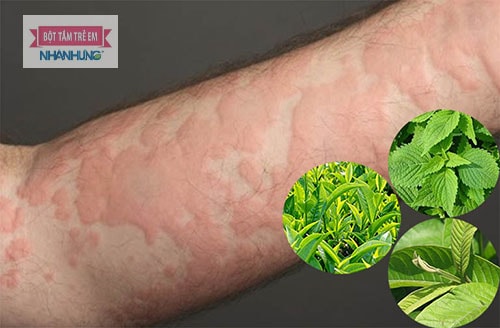 Các loại lá dân gian hiệu quả trong điều trị mề đay ở trẻ.