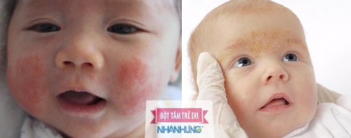 Trẻ sơ sinh bị khô da mặt và toàn thân