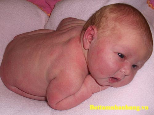 Trẻ sơ sinh hay nằm nhiều nên dễ dàng bị rôm sảy ở lưng