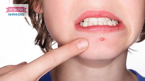 Mụn nhọt có thể gặp phải ở bất cứ lứa tuổi nào.