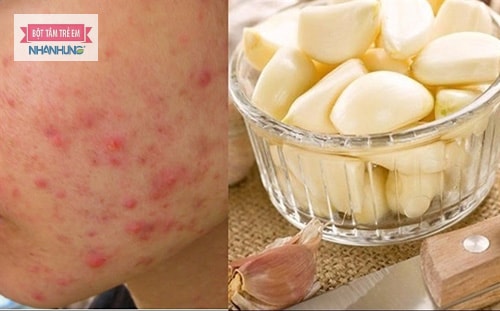 Đắp tỏi lên da giúp chữa mụn nhọt sưng tấy tại nhà nhanh chóng.
