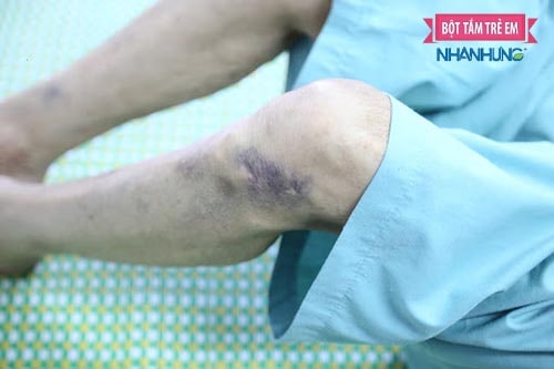 Da bầm tím là dấu hiệu giảm tiểu cầu khi bị sốt xuất huyết