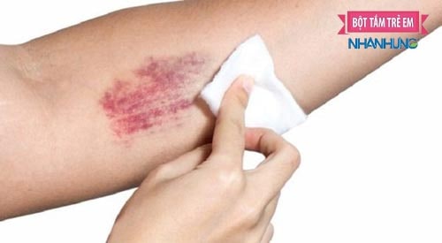 Hiện tượng giảm tiểu cầu rất nguy hiểm