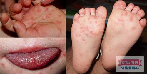 Bệnh tay chân miệng làm xuất hiện viêm da bóng nước ở trẻ em.