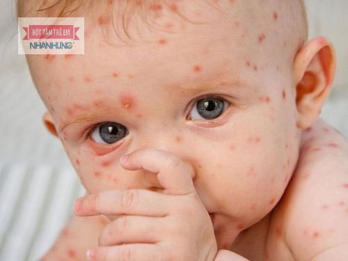 Viêm da bóng nước ở trẻ bị thủy đậu.