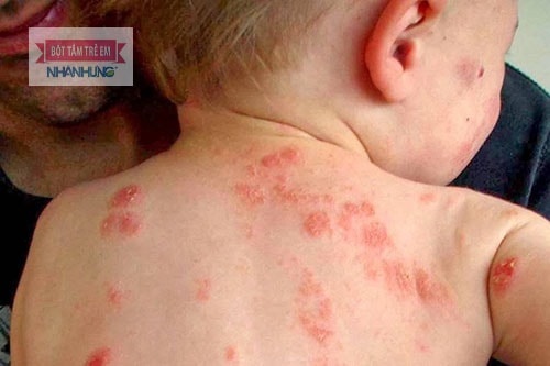 Bệnh zona làm xuất hiện viêm da bóng nước ở trẻ em.
