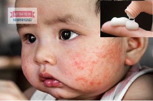 Sử dụng thuốc bôi tại chỗ hạn chế triệu chứng viêm da bóng nước ở trẻ em.