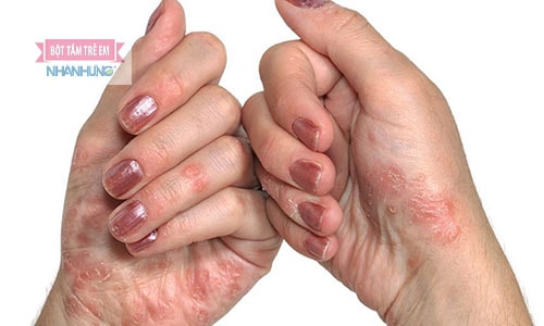 Viêm da dị ứng xảy ra khi có tác động của các yếu tố dị nguyên.
