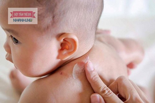 Sử dụng kem bôi ngoài làm mềm da giúp giảm triệu chứng viêm da dị ứng