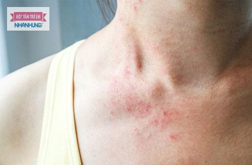 Điều kiện thời tiết nóng bức gây ra viêm da dị ứng thời tiết.