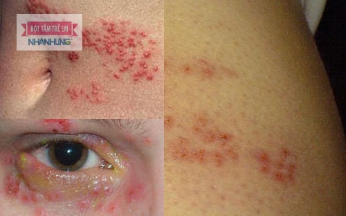Viêm da thần kinh gồm 4 dạng khác nhau.