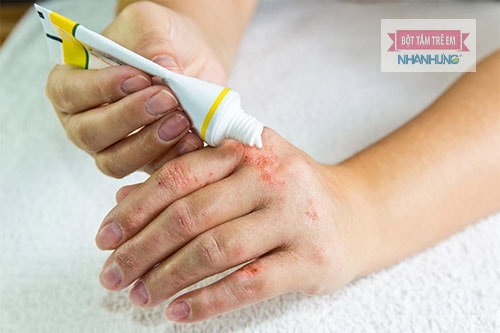 Sử dụng thuốc bôi tại chỗ hạn chế triệu chứng viêm da thần kinh.