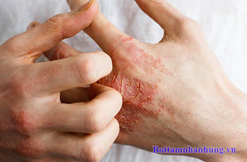 Viêm da tiếp xúc là bệnh không lây nhiễm.