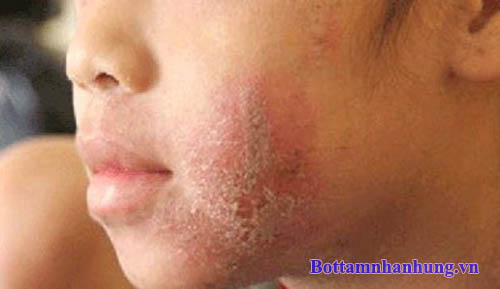 Viêm da tiếp xúc gây ngứa ngày khó chịu mất thẩm mỹ