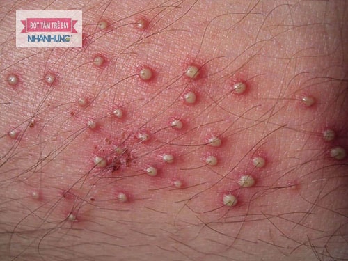Bệnh viêm nang lông làm vùng kín bị ngứa và nổi mẩn đỏ.