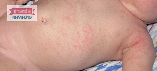 Rất nhiều trẻ bị ngứa khắp người không rõ nguyên nhân.
