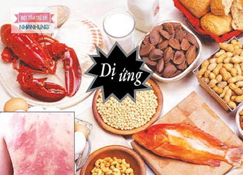 Ăn thực phẩm dễ dị ứng có khả năng bị dị ứng mẩn ngứa.