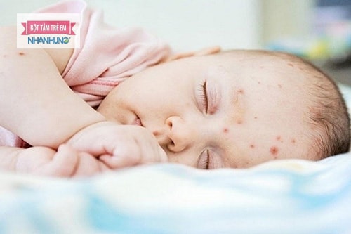 Trẻ sơ sinh bị nóng trong người có thể gây ra mụn nhọt.