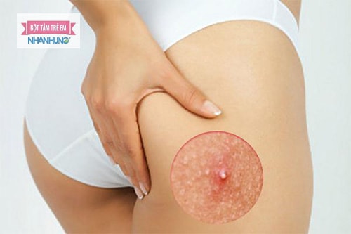 Mụn nhọt ở mông sưng to do nhiều nguyên nhân khác nhau.