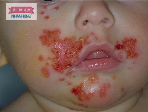 Bệnh chốc mép ở trẻ do virut gây nên và thường xuất hiện tổn thương ở mép môi