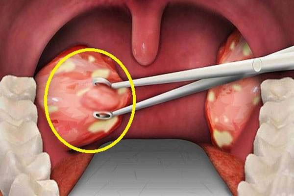  Viêm amidan hốc mủ là tình trạng bệnh mãn tính, xuất hiện mủ.
