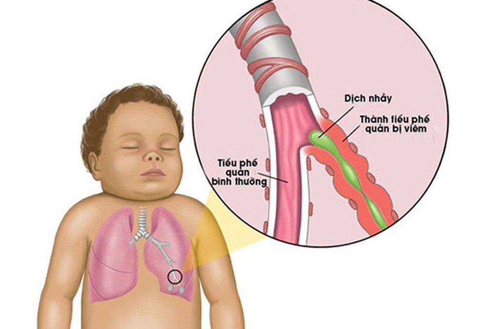 4. Cách chăm sóc bé bị viêm tiểu phế quản tại nhà