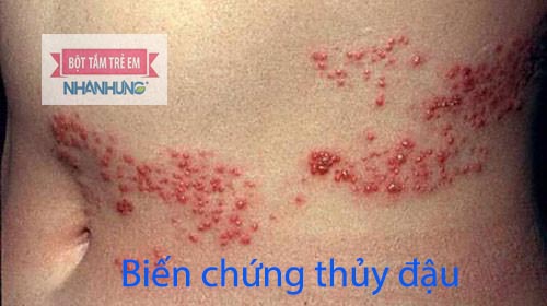 Biến chứng thủy đậu gây bệnh zona thần kinh
