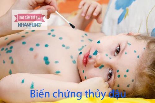 Chăm sóc đúng cách người bị thủy đậu để hạn chế biến chứng