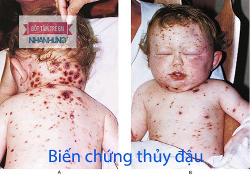 Thủy đậu gây nên biến chứng nhiễm trùng
