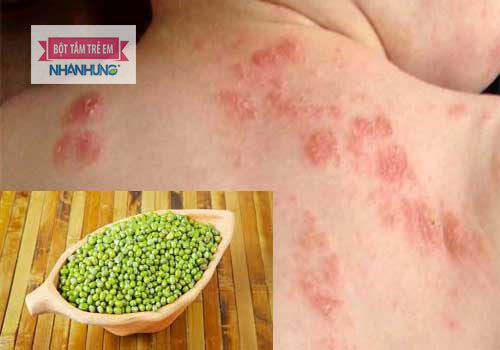 Không nên đắp bột đậu xanh, lá cây lên vùng da bị giời leo của trẻ