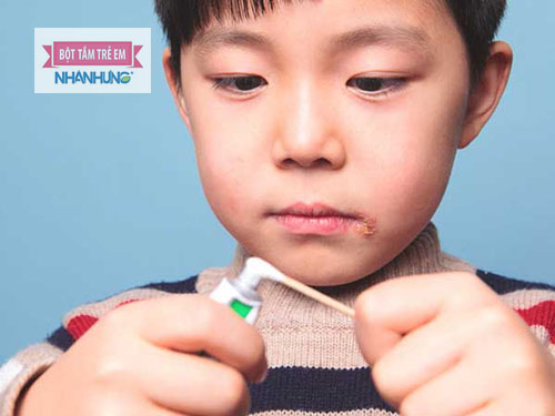 Bệnh giời leo ở trẻ em