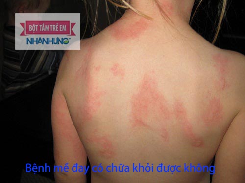 Mề đay có thể nổi ở bất cứ đâu trê cơ thể trẻ